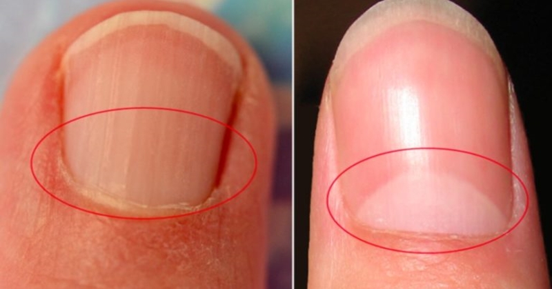 If You Don’t Have A Half Moon Shape On Your Nails, Visit A DOCTOR Immediately