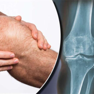 Mos e humbisni – Eshtë kura natyrale për artritin, reumatizmën, dhimbjet në gjunjë