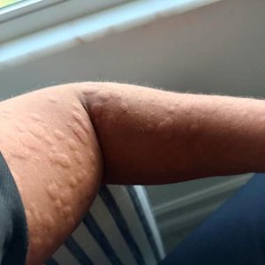 I started babysitting my neighbors son about 2 days ago and he started having these spots appear on him a few hours after he came from his friend house and since I was around him and putting him to sleep when I woke up this morning I had these inflamed itchy spots all over my upper body… what is this 🙁 608812642_1177388534609938_2111257895092086827_n